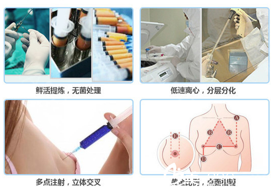 北京京民整形JM高选择性三维立体自体脂肪移植术过程示意图
