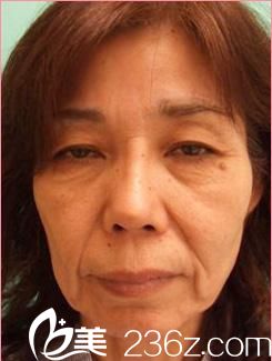 佐藤大介拉皮手术前 佐藤大介拉皮手术前