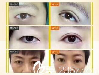 荆门和丽郑芳蓉双眼皮案例 荆门和丽郑芳蓉双眼皮案例