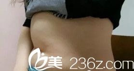 在衡水天宏做腰腹吸脂术前腰部肥胖 在衡水天宏做腰腹吸脂术前腰部肥胖