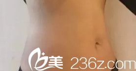 衡水天宏杨辉医生做腰腹吸脂18天后已经消肿 衡水天宏杨辉医生做腰腹吸脂18天后已经消肿