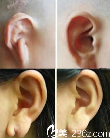 山西省整形外科孟庆璋医生耳部修复案例效果图