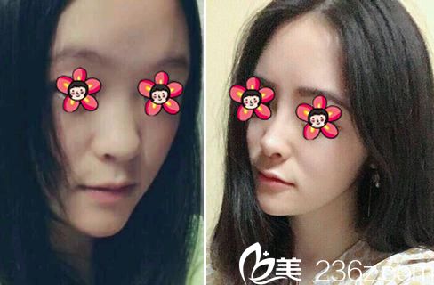 义乌张小红鼻综合隆鼻案例 义乌张小红鼻综合隆鼻案例