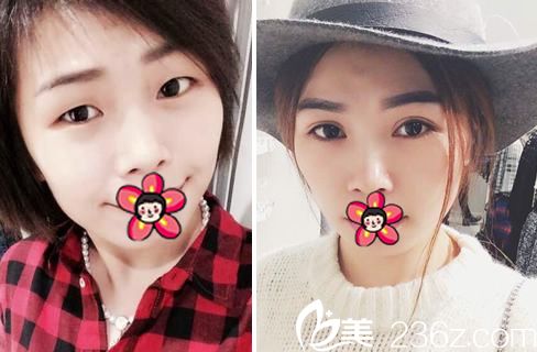 邓亮医生割双眼皮开眼角案例 邓亮医生割双眼皮开眼角案例