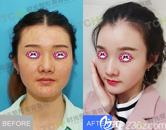 我在重庆时光整形医院祛斑前后效果图 我在重庆时光整形医院祛斑前后效果图