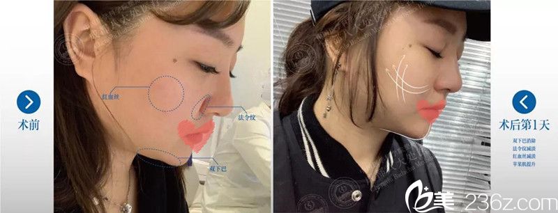 成都<!--<i data=20240709-sp></i>-->整形王萍线雕案例 成都<!--<i data=20240709-sp></i>-->整形王萍线雕案例