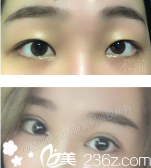 成都<!--<i data=20240709-sp></i>-->于晓波双眼皮术后照片 成都<!--<i data=20240709-sp></i>-->于晓波双眼皮术后照片