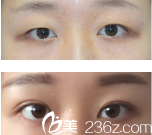 于晓波微创三点双眼+开眼角 于晓波微创三点双眼+开眼角
