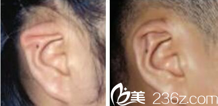 <!--<i data=20240709-sp></i>-->于晓波耳畸形修复术后效果 <!--<i data=20240709-sp></i>-->于晓波耳畸形修复术后效果