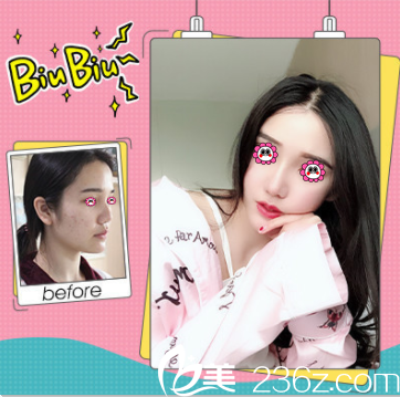 北京壹加壹蒙特鼻多少钱？隆鼻价格表和案例抢先看