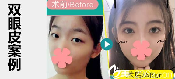 福州台江徐婷婷双眼皮案例