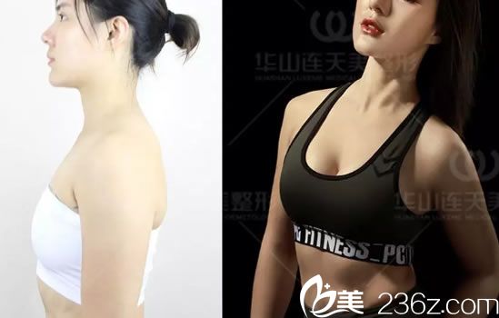 杭州连天美程琳假体隆胸案例