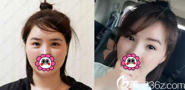 <!--<i data=20240703-sp></li>
<li><i data=20240703-sp></i>-->赵惠春双眼皮修复案例