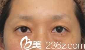 日本整形之旅，找高须美容整形的高须克弥医生为我做的切开法双眼皮和眼睑下垂修正手术