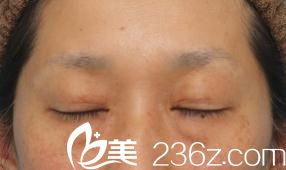 切开法双眼皮和眼睑下垂修正手术后闭眼时候的样子