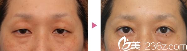 切开法双眼皮和眼睑下垂修正手术前后对比