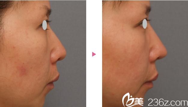鼻尖软骨移植前后对比