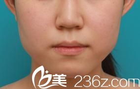 脸型整形前 脸型整形前