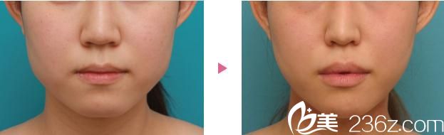 脸型整形前后对比 脸型整形前后对比