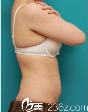 吸脂手术前 吸脂手术前
