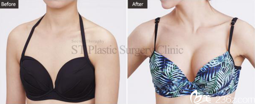 韩国ST整形外科案例 韩国ST整形外科案例