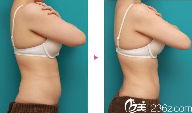吸脂手术前后对比 吸脂手术前后对比