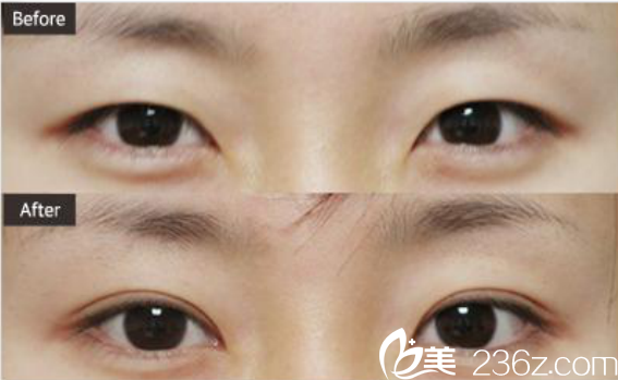 韩国ST整形外科医院案例 韩国ST整形外科医院案例