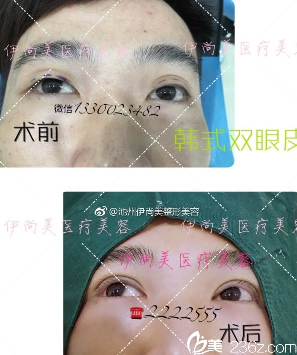 跨年大促池州伊尚美整形优惠价格表公布 除皱针/瘦脸年卡仅需2980元