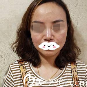 假体隆鼻失败的我 假体隆鼻失败的我