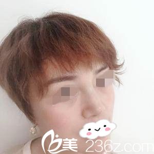 鼻修复一周后的效果 鼻修复一周后的效果