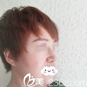 鼻修复半个月的效果 鼻修复半个月的效果