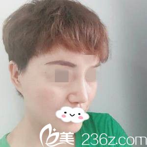 假体隆鼻失败的我慕名找了哈尔滨的刘非医生做了鼻修复，术后一个月就让我拥有了高挺俊俏的美鼻