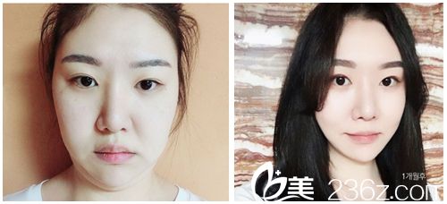 韩国dreamline吸脂塑形医院面部吸脂<span style= 韩国dreamline吸脂塑形医院面部吸脂<span style=