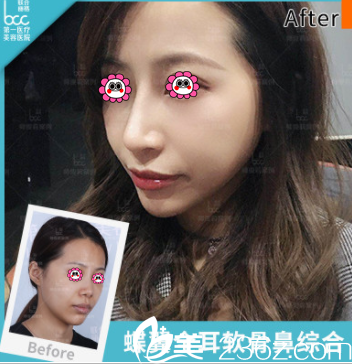 北京联合丽格师俊莉耳软骨鼻综合案例 北京联合丽格师俊莉耳软骨鼻综合案例