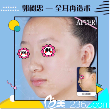 北京联合丽格全耳再造案例 北京联合丽格全耳再造案例