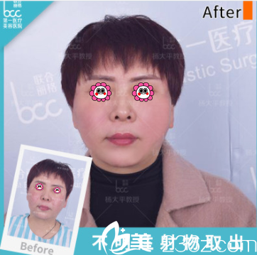 北京联合丽格杨大平医生脸部不明物取出案例