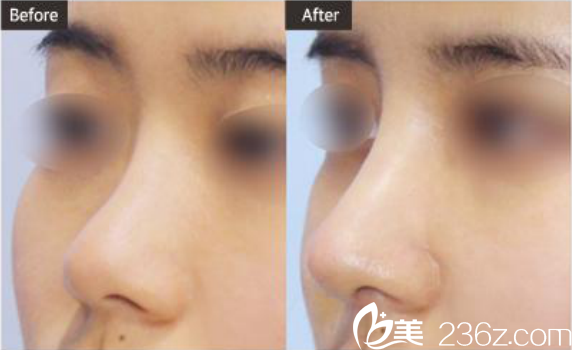 韩国ST整形外科医院扁平鼻对比图