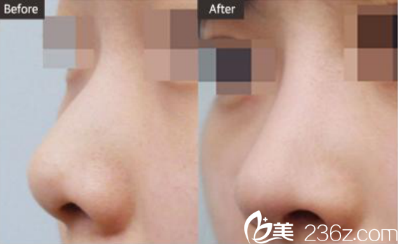 韩国ST整形医院短鼻/鹰钩鼻对比图 韩国ST整形医院短鼻/鹰钩鼻对比图