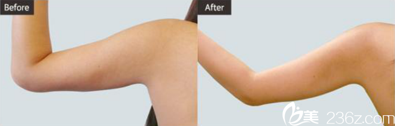 韩国ST整形医院吸脂术对比图 韩国ST整形医院吸脂术对比图