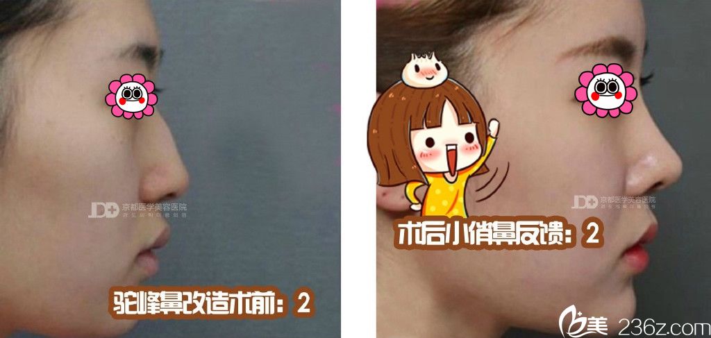 保定京都整形隆鼻前后对比照 保定京都整形隆鼻前后对比照