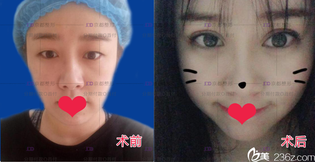 保定京都双眼皮效果图 保定京都双眼皮效果图