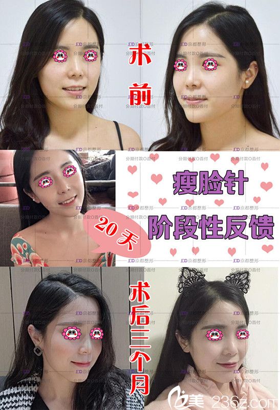 我在保定京都打完瘦脸1-3个月变化图 我在保定京都打完瘦脸1-3个月变化图