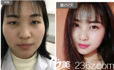 切开双眼皮案例