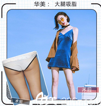 华美孙奇医生做吸脂手术案例