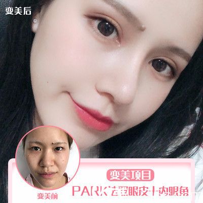 深圳非凡黄纯做的双眼皮开眼角案例 深圳非凡黄纯做的双眼皮开眼角案例