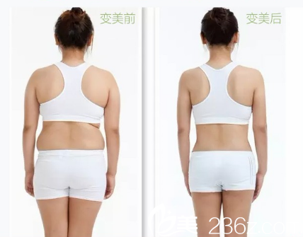 深圳非凡黄纯做的腰腹部吸脂案例 深圳非凡黄纯做的腰腹部吸脂案例