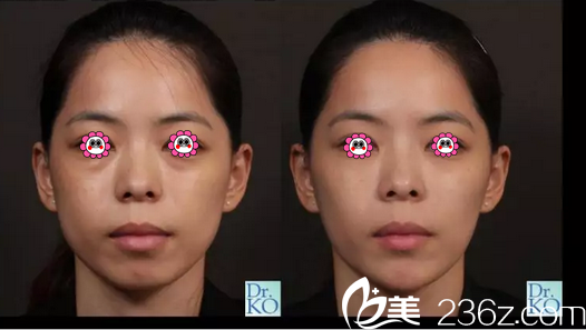 柯威志博士注射案例