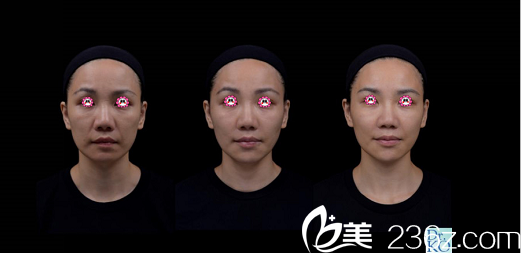 柯威志博士注射案例