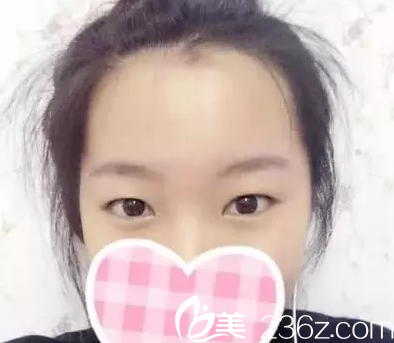 在玉林华美做双眼皮手术前 在玉林华美做双眼皮手术前