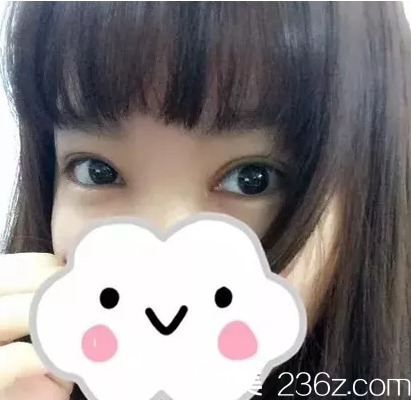 在玉林华美做双眼皮手术20天后改善了我的肿眼泡单眼皮